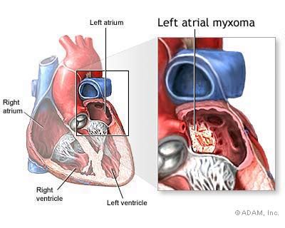 right atrial myxoma symptoms